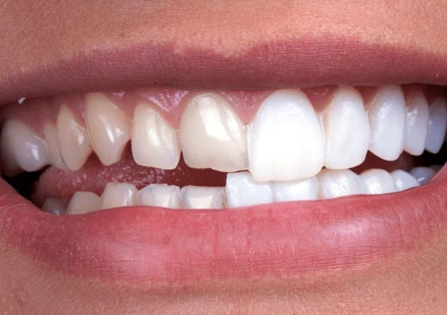 Porcelain Veneers